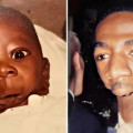 하관쪽 얼굴이 사라진 채로 태어난 남자의 20년 뒤 소름 돋는 변화 ㄷㄷ