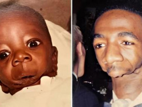 하관쪽 얼굴이 사라진 채로 태어난 남자의 20년 뒤 소름 돋는 변화 ㄷㄷ