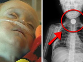 자신의 생일날 열이 나서 병원을 찾은 1살 아이의 ‘목에서 발견된 물건’의 정체