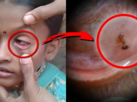 눈에서 끊임없이 ‘개미’가 나오는 11살 소녀