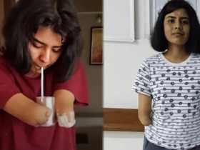 남자의 두 팔을 이식 받은 16살 소녀의 3년 뒤 소름돋는 변화